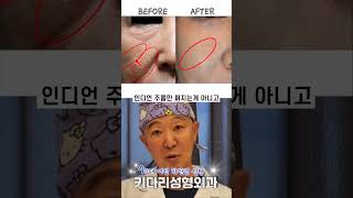 하안검 성형 성형 시술