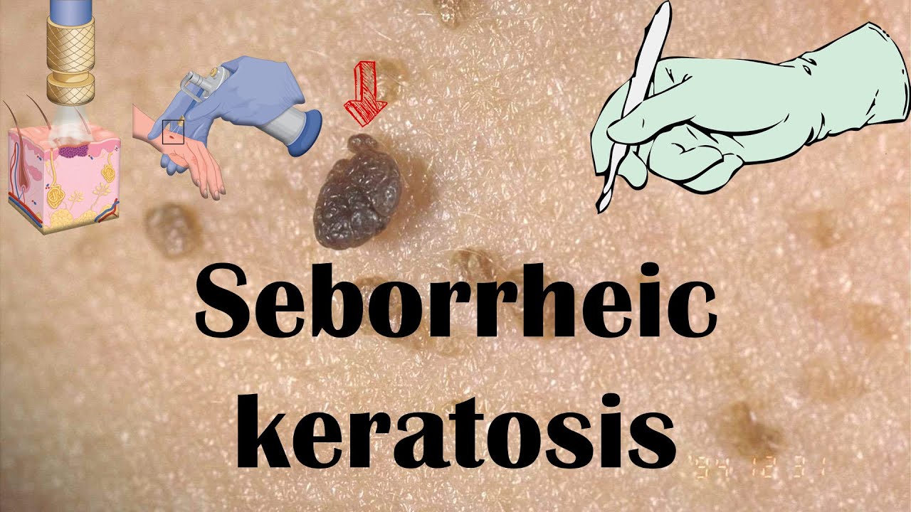 Seborrheic Keratosis (Dermatitis) [Age Spots] - Causes, Signs & Symptoms & Treatment