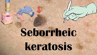 Seborrheic Keratosis (Dermatitis) [Age Spots] - Causes, Signs & Symptoms & Treatment