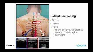 Ultrasound-Guided Regional Anaesthesia for Cardiac Surgery