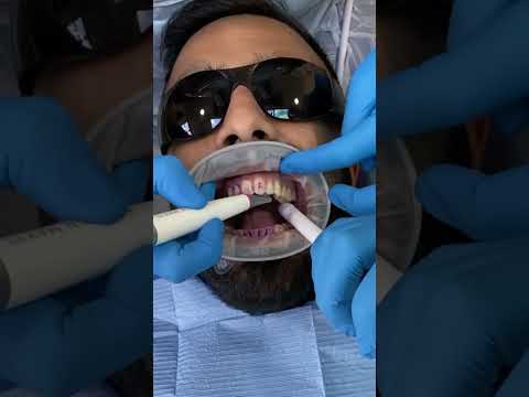 GBT Airflow Dental Hygiene Treatment Stain Removal