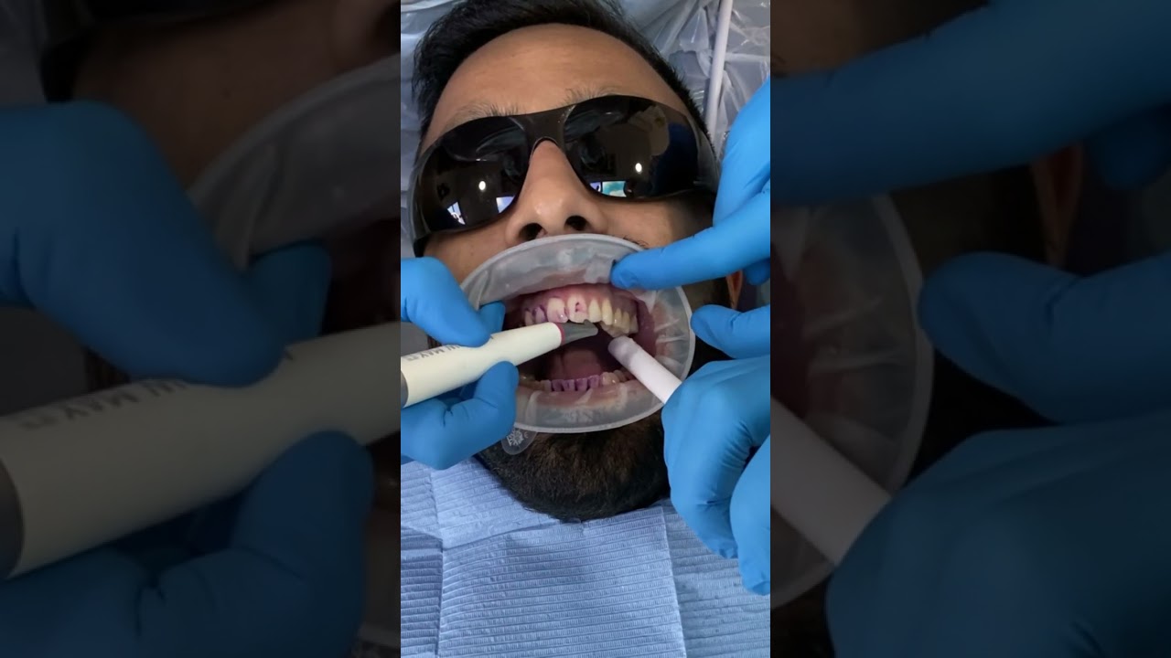 GBT Airflow Dental Hygiene Treatment Stain Removal