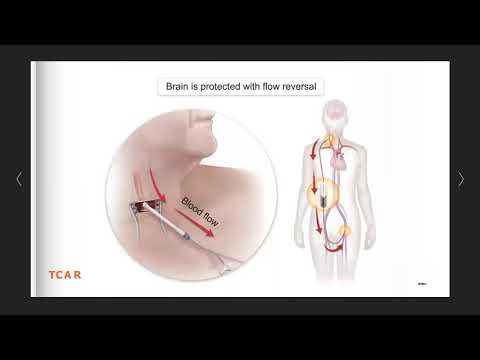 Transcarotid Artery Revascularization (TCAR) procedure