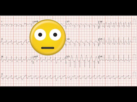 12-lead EKG Made Ridiculously Easy
