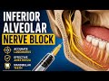 Inferior Alveolar Nerve Block IANB Step By Step Technique Dr Raj Dentistry