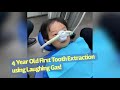 4 Year Old First Tooth Extraction Kids Dental Laughing Gas Tooth Inflammation