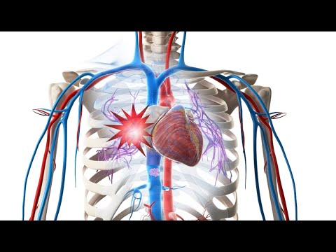 Smedex Trailer - Die Lungenembolie - E-Learning für den Rettungsdienst & die Notfallmedizin