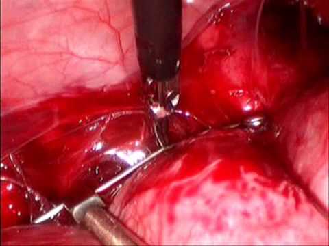 Laparoscopic Cervico-Isthmic Cerclage