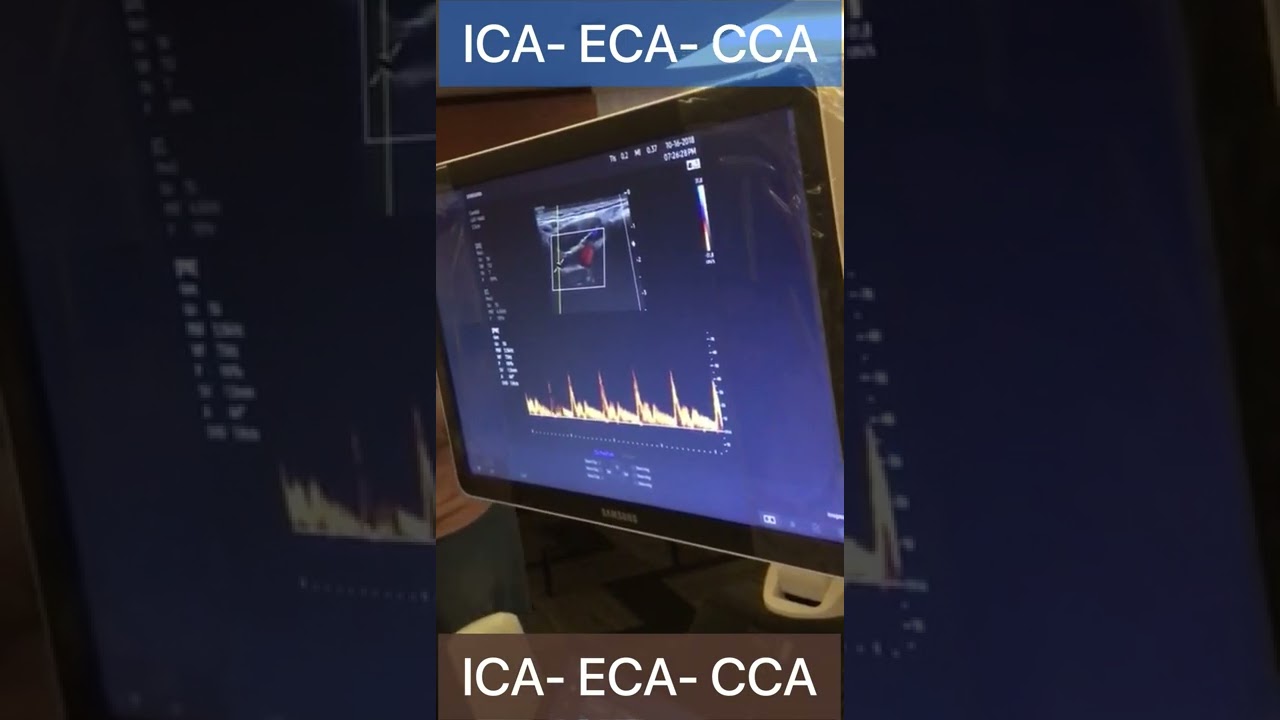 ICA- ECA- CCA Doppler : Technical tips / Arabic Version