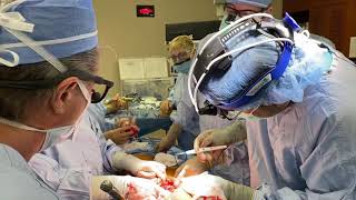 Download Lagu Descending thoracic aortic aneurysm (DTAA) w/ reverse elephant trunk graft u0026 distal aortic perfusion Thumbnail