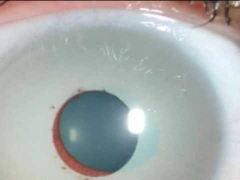 Quanto Costa Cambiare Il Colore Degli Occhi