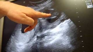 16 weeks gender ultrasound - It's a...