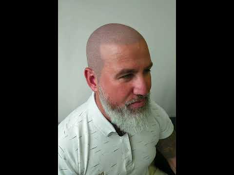 FREE Scalp Micropigmentation Virtual hairline #scalpmicropigmentation #skalp