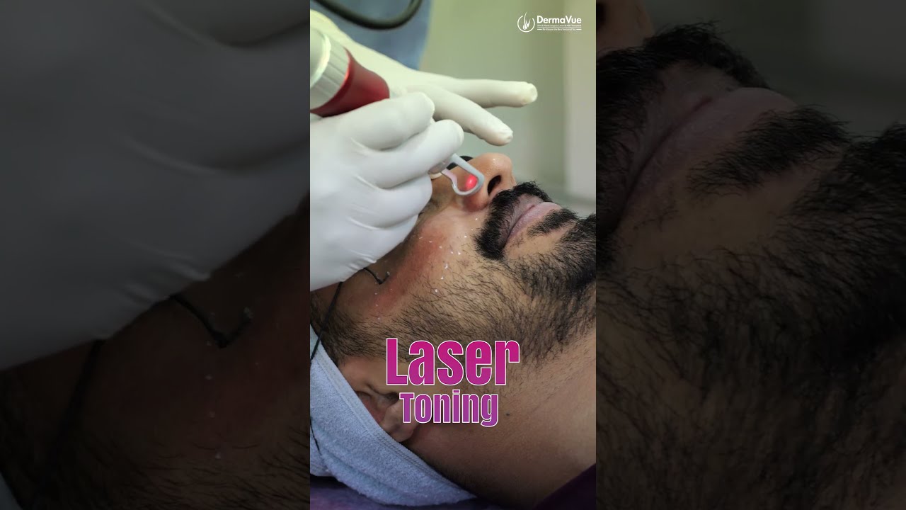 Laser Toning for Pigmentation & Glowing Skin