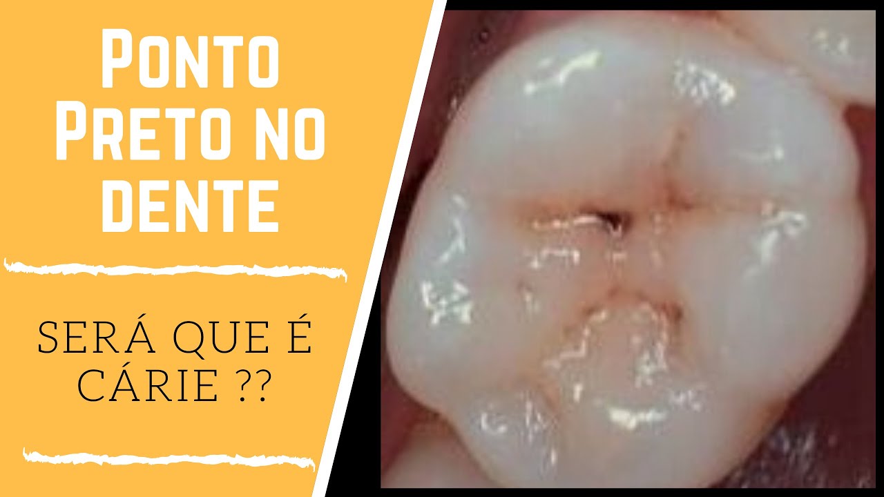 Ponto Preto no Dente - Será uma Cárie 