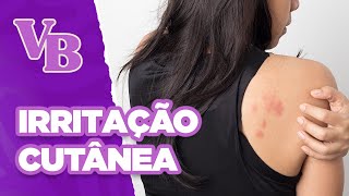 URTICÁRIA: seus tipos, causas e tratamentos - Você Bonita (10/06/2024)