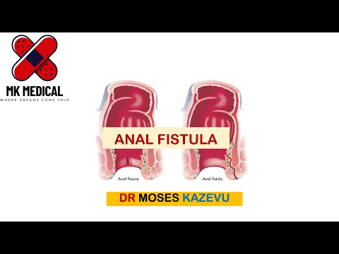 Anal Fistula