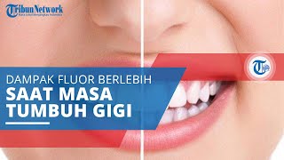 Fluorosis, Kelainan Struktur Email Bercak atau Cacat (Mottled Enamel) Dampak Asupan Fluor Berlebih