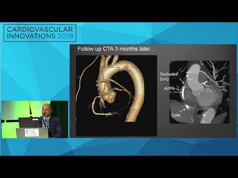CVI2018 Session: How to (effectively) close an SVG - Catalin Toma, MD
