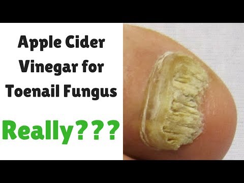 Itinuturing ng kuko halamang-singaw Sochi Paghahanda para sa pagsira fungus