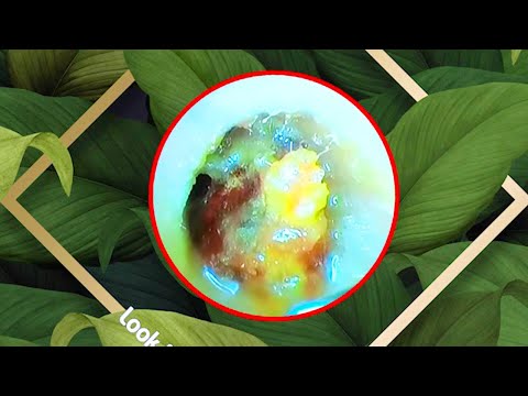 귀지 제거 만족 ear wax removing satisfying