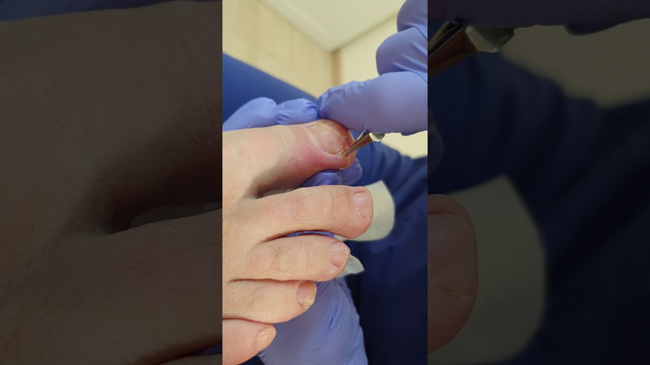 Вросший ноготь, болит большой палец на ноге