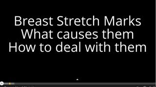 Breast Stretch Marks - Get rid of Stretch marks on breasts