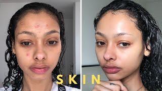 How my forehead acne cleared up