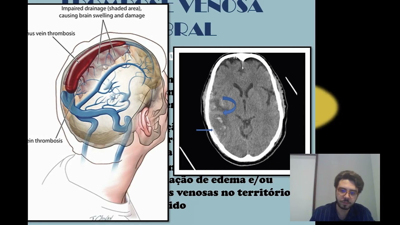 Aula - Trombose Venosa Cerebral - Graduação