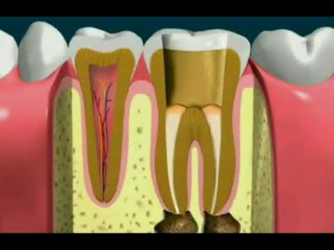 Tratamento de canal veja como é feito.