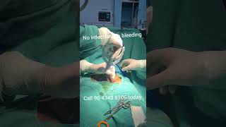 Download lagu #shorts #zsr stapler circumcision #how I do it mp3