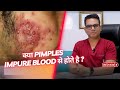 Do pimples occur due to impure blood? | Pimples Treatment in Delhi |  SkinQure