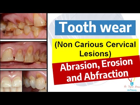 Tooth Wear | Non Carious Cervical Lesions