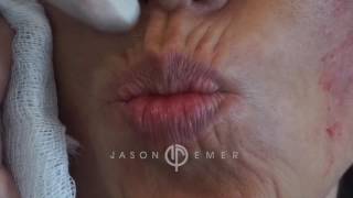 GET BOTOX FOR FINE MOVEMENT LINES & WRINKLES AROUND THE MOUTH| PERIORAL REJUVENATION |Dr. JASON EMER
