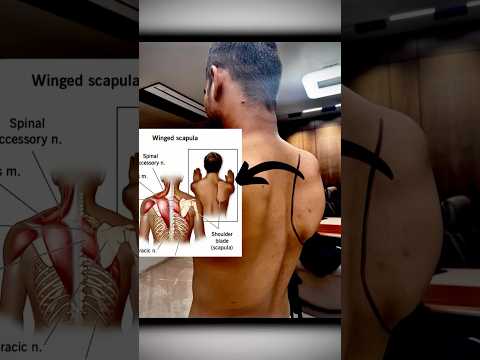 Winging of Scapula vs. Posture Defects: Key Differences #feed #ytshort #trend