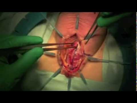 Uretroplastyka zwężenia części opuszkowej cewki moczowej.