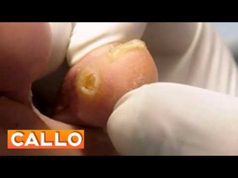 Patch dal mal di schiena prezzo Voltaren Infiammazione nel trattamento congiunto di rimedi popolari