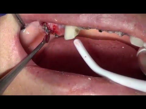 Como extrair dente com multi raizes com um minimo de trauma para o osso