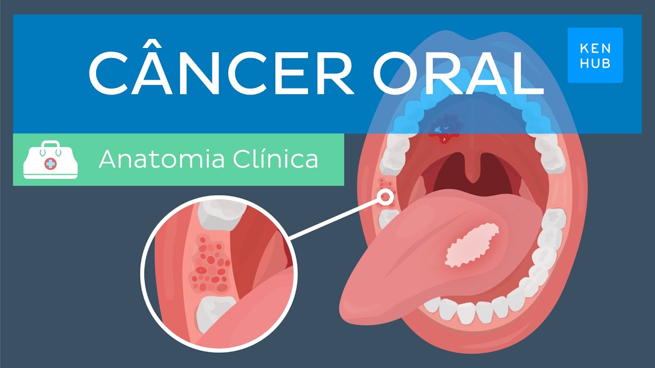 Câncer oral: Epidemiologia, fatores de risco, prevenção, sintomas, diagnóstico e tratamento | Kenhub