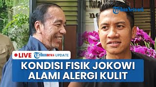 LIVE: Jokowi Bantah Kena Steven Johnson Syndrome, Ajudan: Alergi Kulit Biasa, Kondisi Mulai Membaik