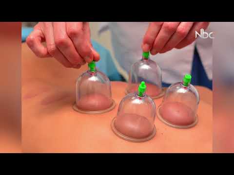 الحجامة وفوائدة