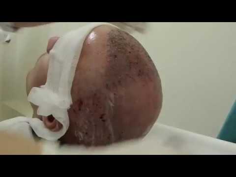 download lagu mp3 mp4 First Wash After Hair Transplant, download lagu First Wash After Hair Transplant gratis, unduh video klip First Wash After Hair Transplant