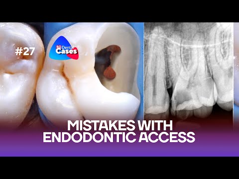 Błędy przy wykonywaniu dostępu endodontycznego | Krok po kroku | Przypadek kliniczny