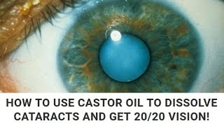 HOW TO USE CASTOR OIL TO DISSOLVE CATARACTS AND GET 20 20 VISION!