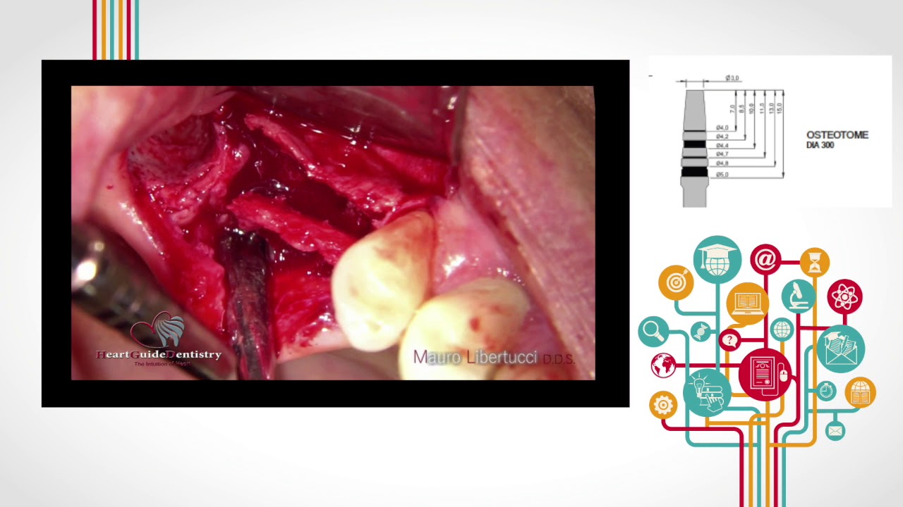 Caso clinico espansione di cresta magnetodinamica 1