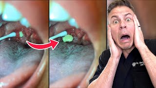 How You Are Removing Tonsil Stones The WRONG Way!
