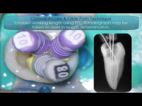 D-Perfect®  NiTi Gold MG3 Files Technique Video  HD