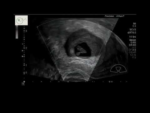 Early Ultrasound - Pregnancy- Week 7+4