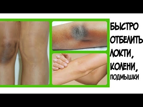 Чтобы не было веснушек у детей Пигментации кожи у ребенка фото