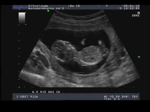 Ultraljud vecka 12+4